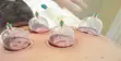 Hijama Therapy - Professional Home Visits - 3