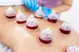 Hijama Therapy - Professional Home Visits - 5