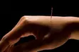 Professional Acupuncture Home Visits - 5